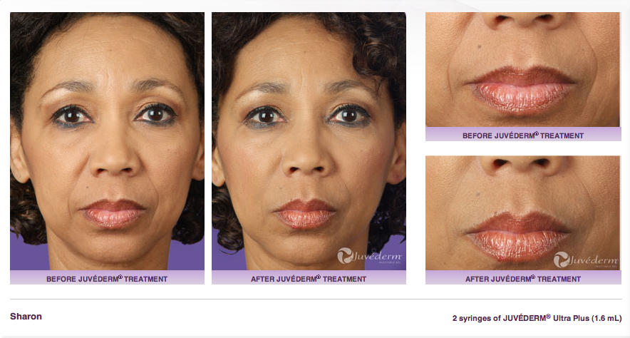 injections for lips newport beach